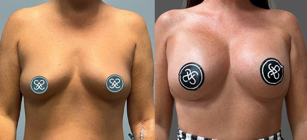 Breast Augmentation Before & After Gallery - Patient 272283 - Image 1