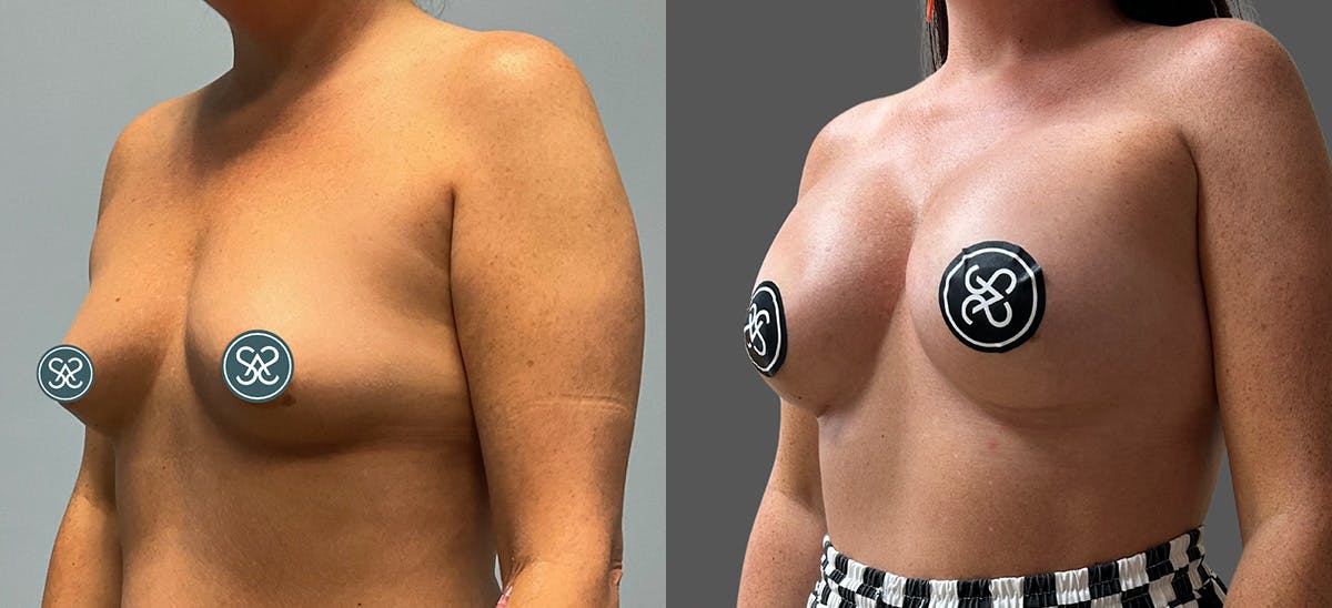 Breast Augmentation Before & After Gallery - Patient 272283 - Image 2