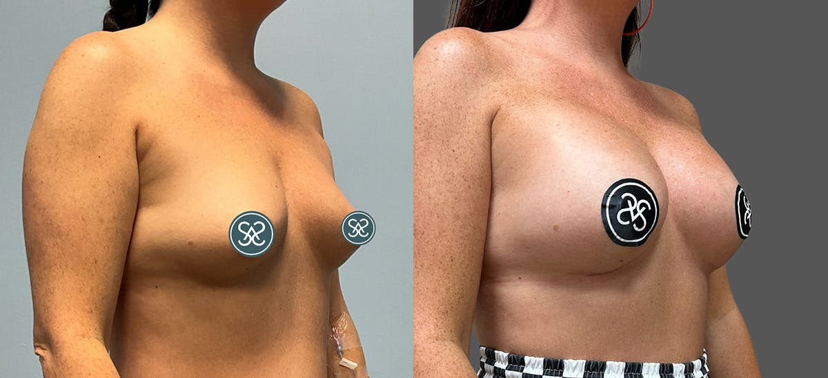 Breast Augmentation Before & After Gallery - Patient 272283 - Image 3