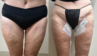 Thigh Lift Before & After Gallery - Patient 112958 - Image 1
