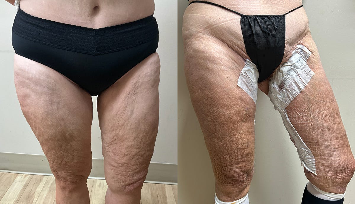 Thigh Lift Before & After Gallery - Patient 112958 - Image 2
