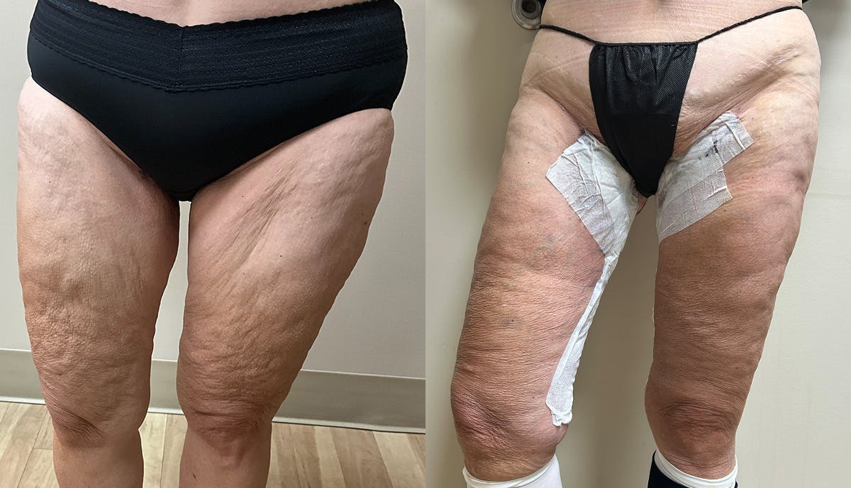 Thigh Lift Before & After Gallery - Patient 112958 - Image 3