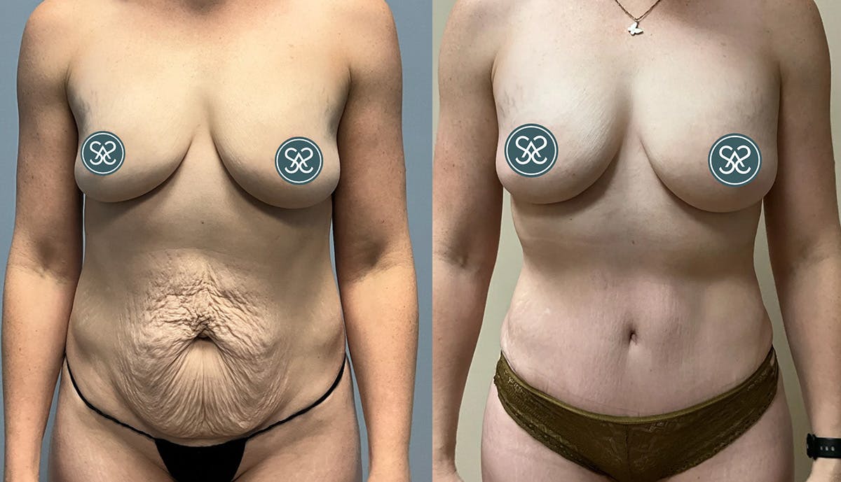 Liposuction Before & After Gallery - Patient 409766 - Image 1