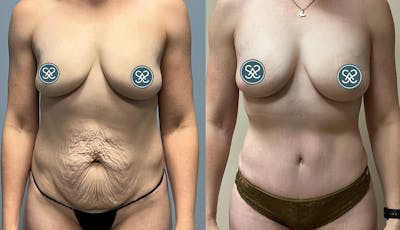 Liposuction Before & After Gallery - Patient 409766 - Image 1