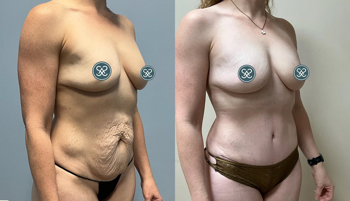 Liposuction Before & After Gallery - Patient 409766 - Image 2