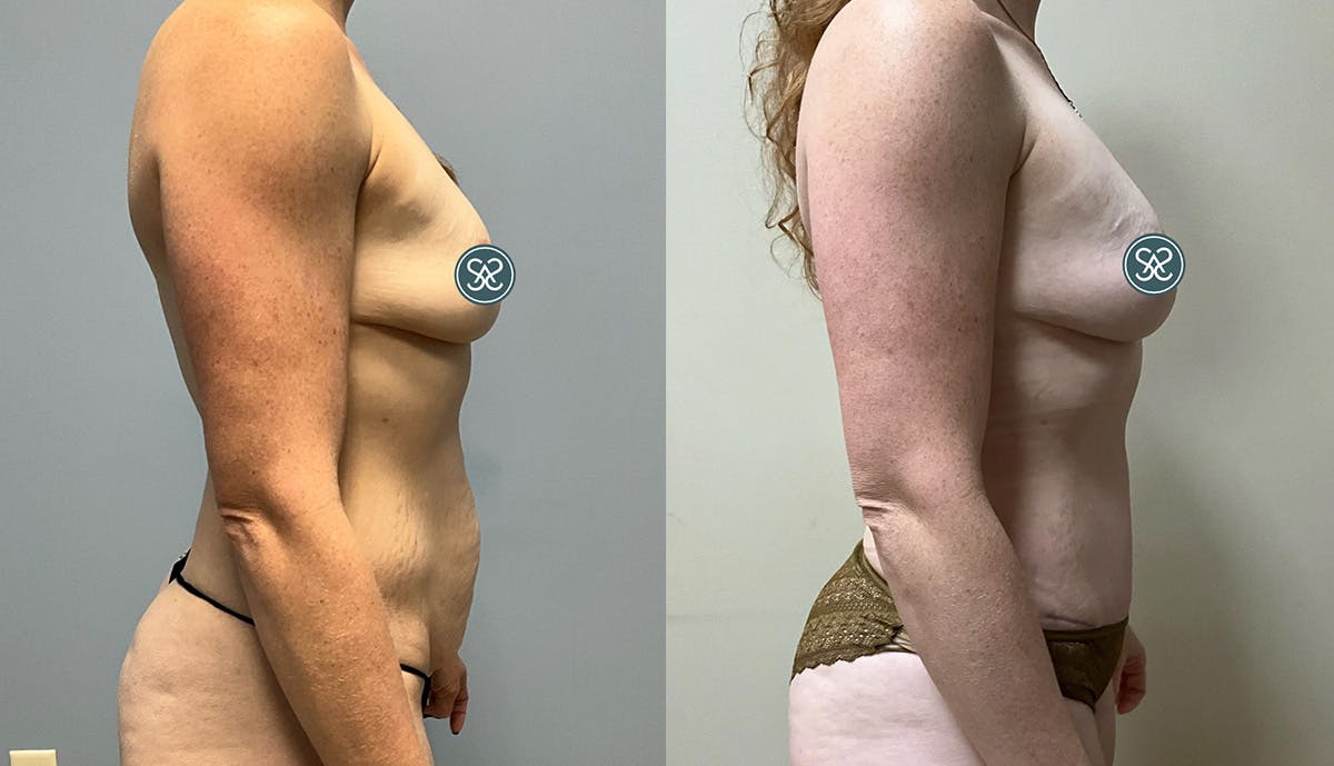 Liposuction Before & After Gallery - Patient 409766 - Image 3