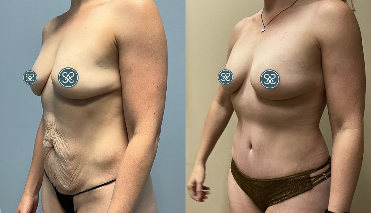 Liposuction Before & After Gallery - Patient 409766 - Image 4