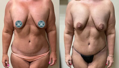 Liposuction Before & After Gallery - Patient 307841 - Image 1