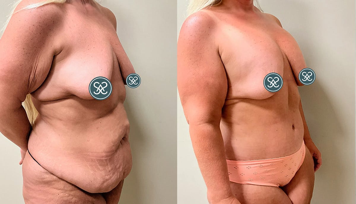 Liposuction Before & After Gallery - Patient 307841 - Image 2