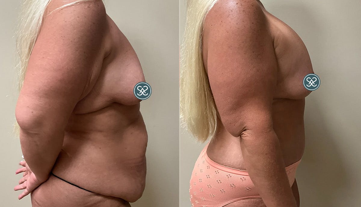 Liposuction Before & After Gallery - Patient 307841 - Image 3