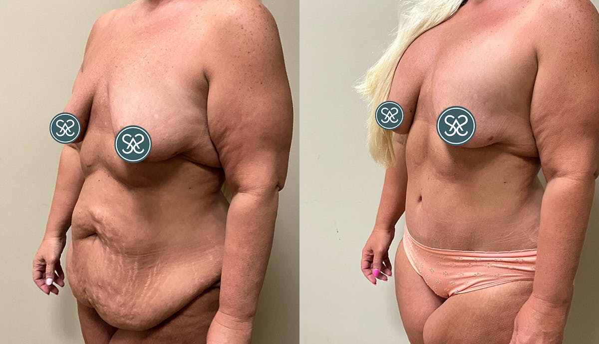 Liposuction Before & After Gallery - Patient 307841 - Image 4