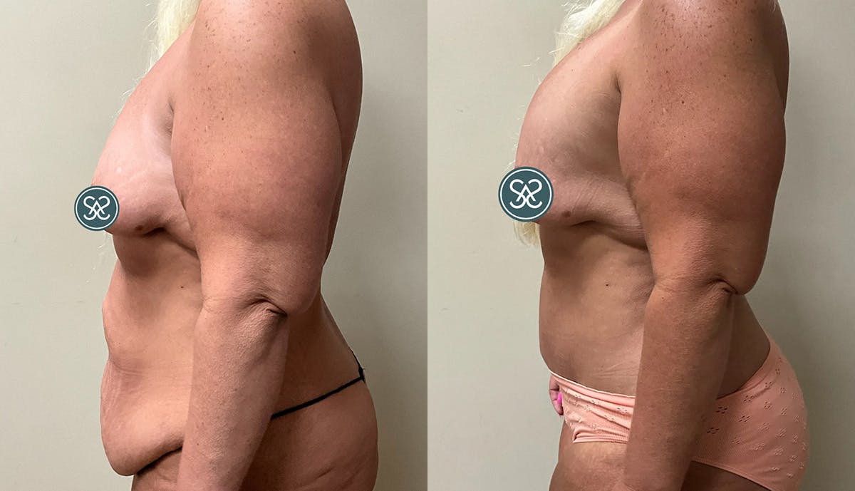Liposuction Before & After Gallery - Patient 307841 - Image 5