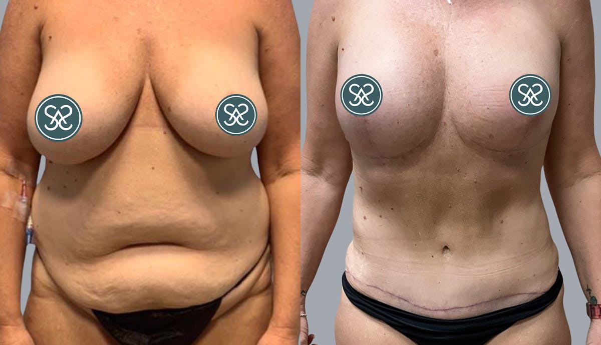 Liposuction Before & After Gallery - Patient 409531 - Image 1