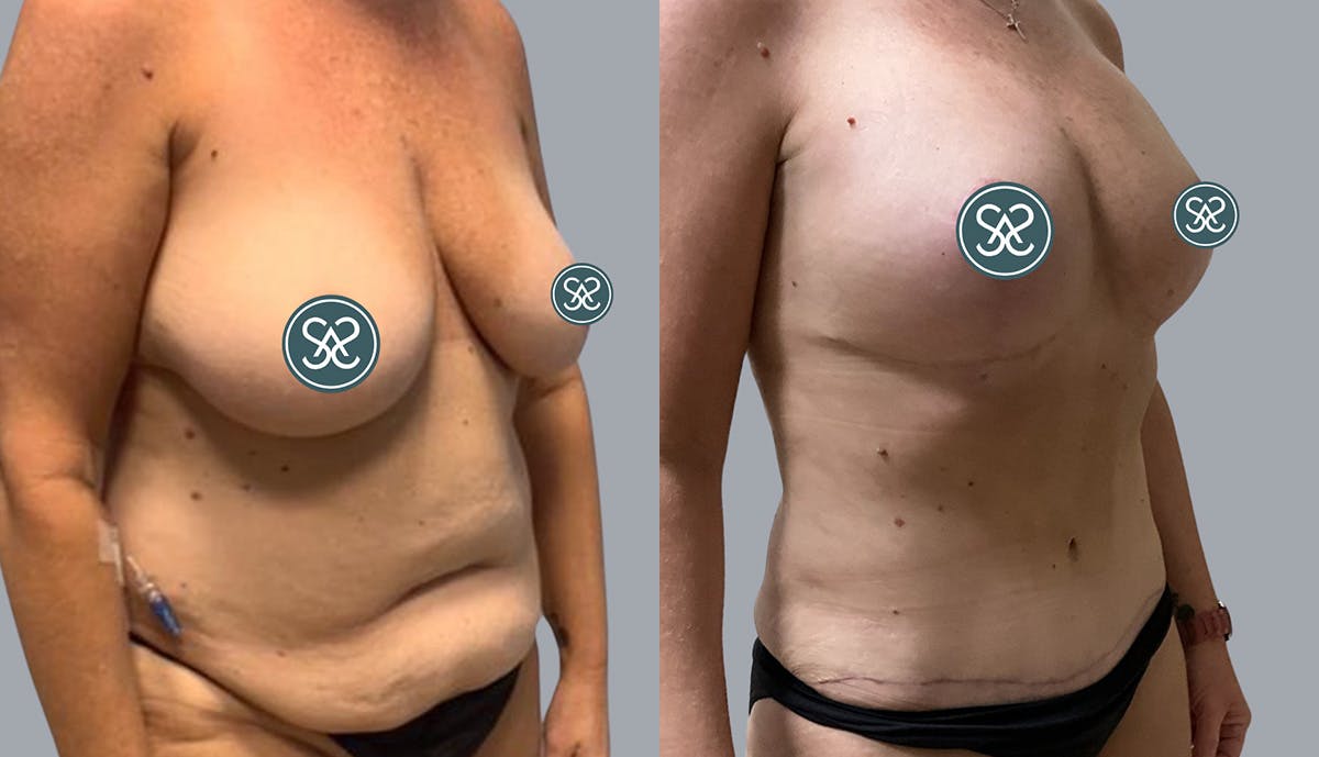 Liposuction Before & After Gallery - Patient 409531 - Image 2