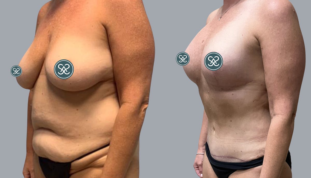 Liposuction Before & After Gallery - Patient 409531 - Image 3