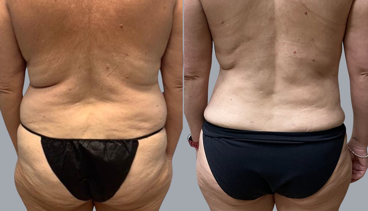Liposuction Before & After Gallery - Patient 409531 - Image 4