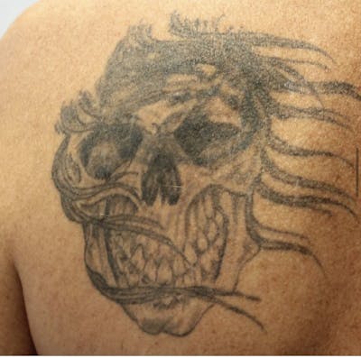 Tattoo Removal Before & After Gallery - Patient 358558 - Image 1