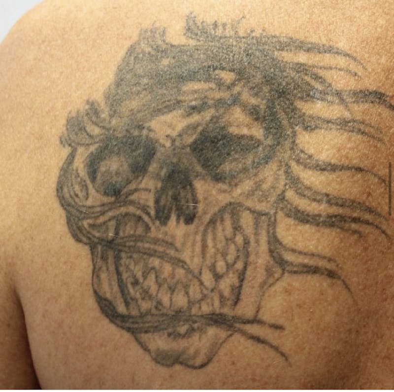 Tattoo Removal Before & After Gallery - Patient 358558 - Image 1