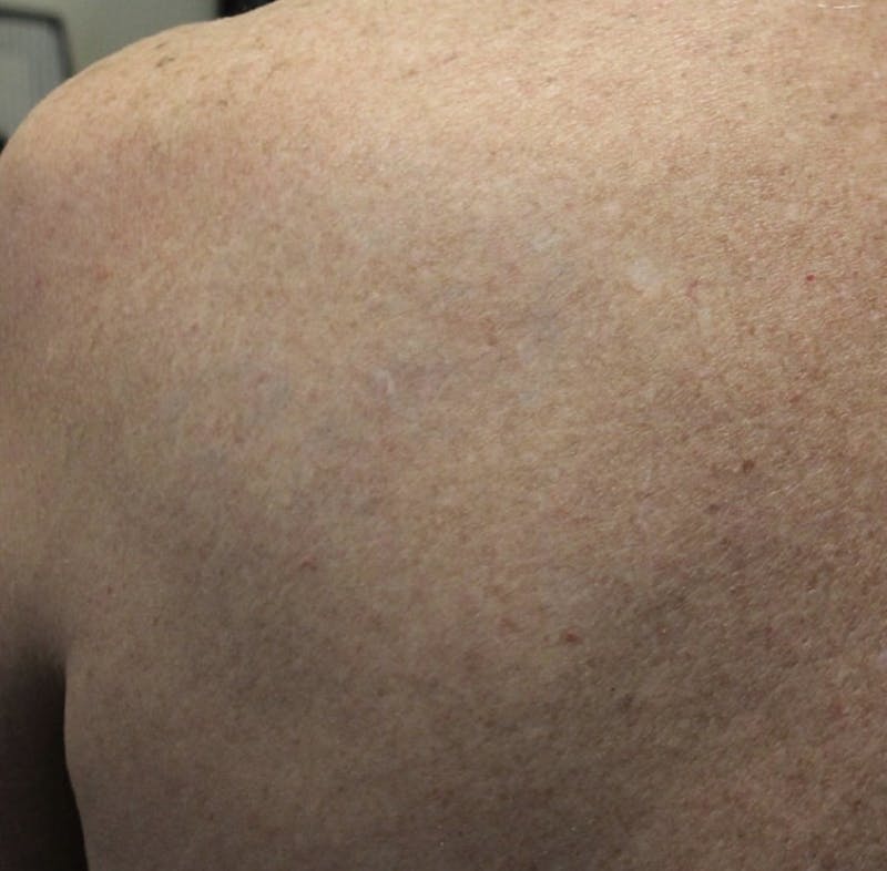 Tattoo Removal Before & After Gallery - Patient 358558 - Image 2