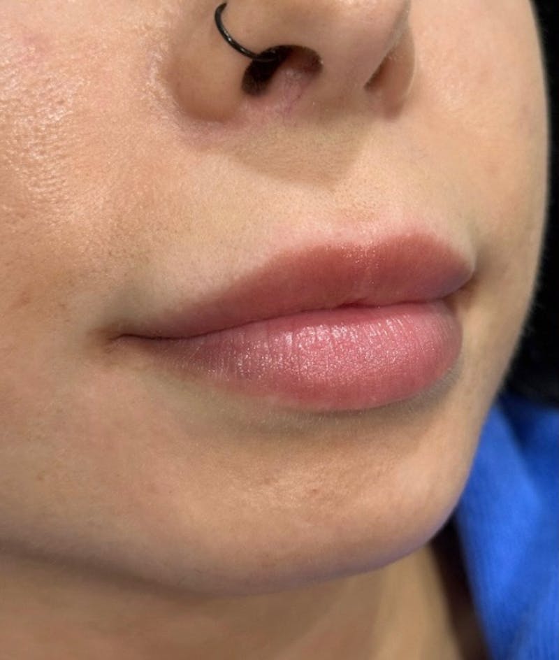 Lip Filler