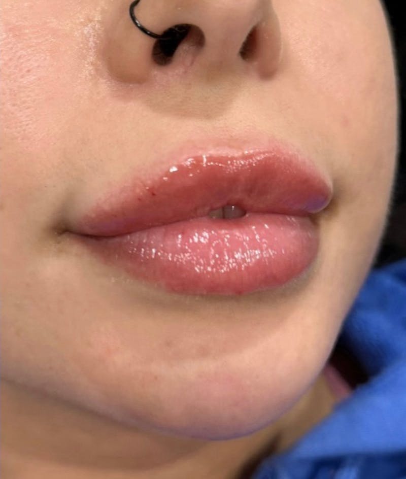 Lip Filler