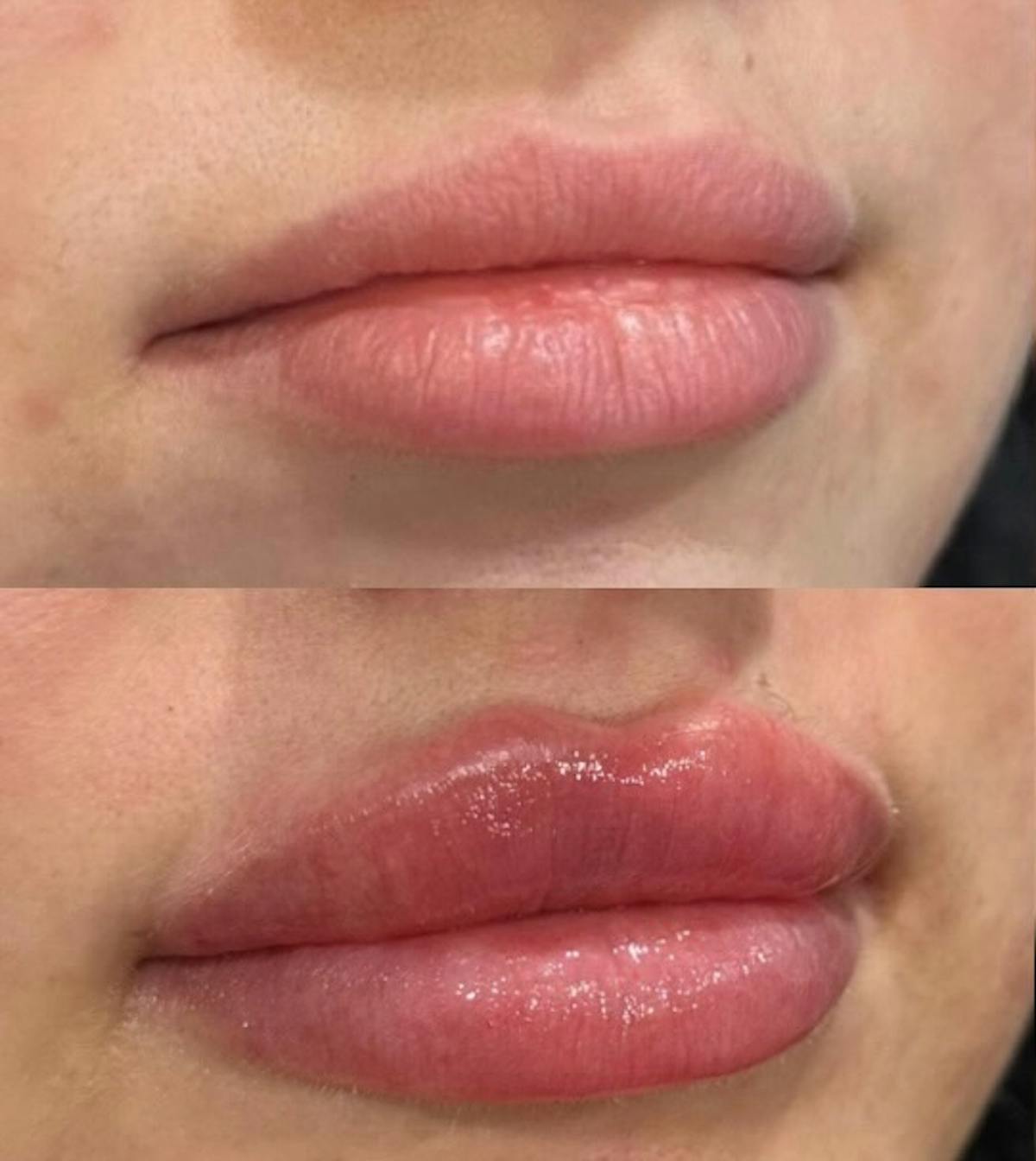 Facial Fillers Before & After Gallery - Patient 226813 - Image 1