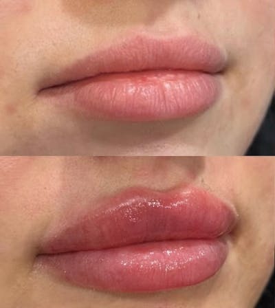 Facial Fillers Before & After Gallery - Patient 226813 - Image 1