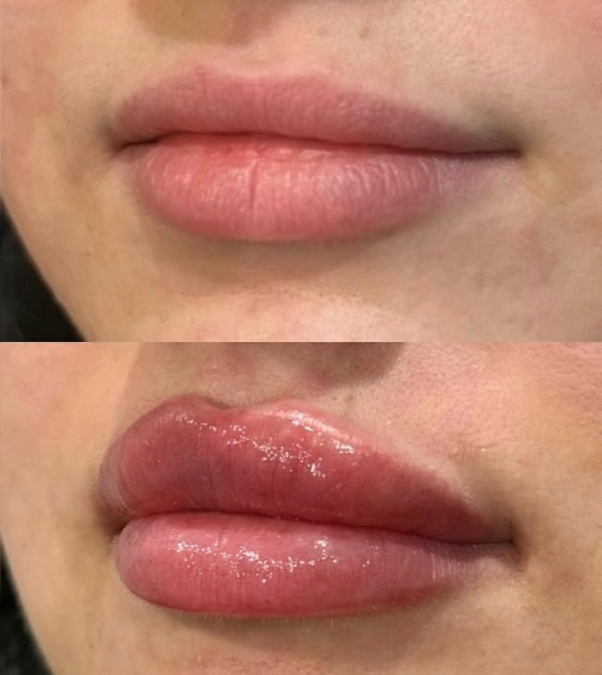 Facial Fillers Before & After Gallery - Patient 226813 - Image 2