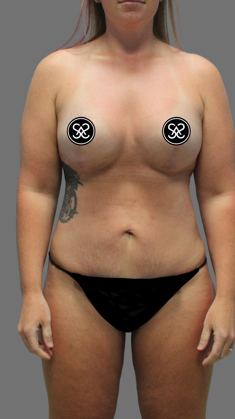 High Definition Mommy Makeover Before & After Gallery - Patient 368571 - Image 2