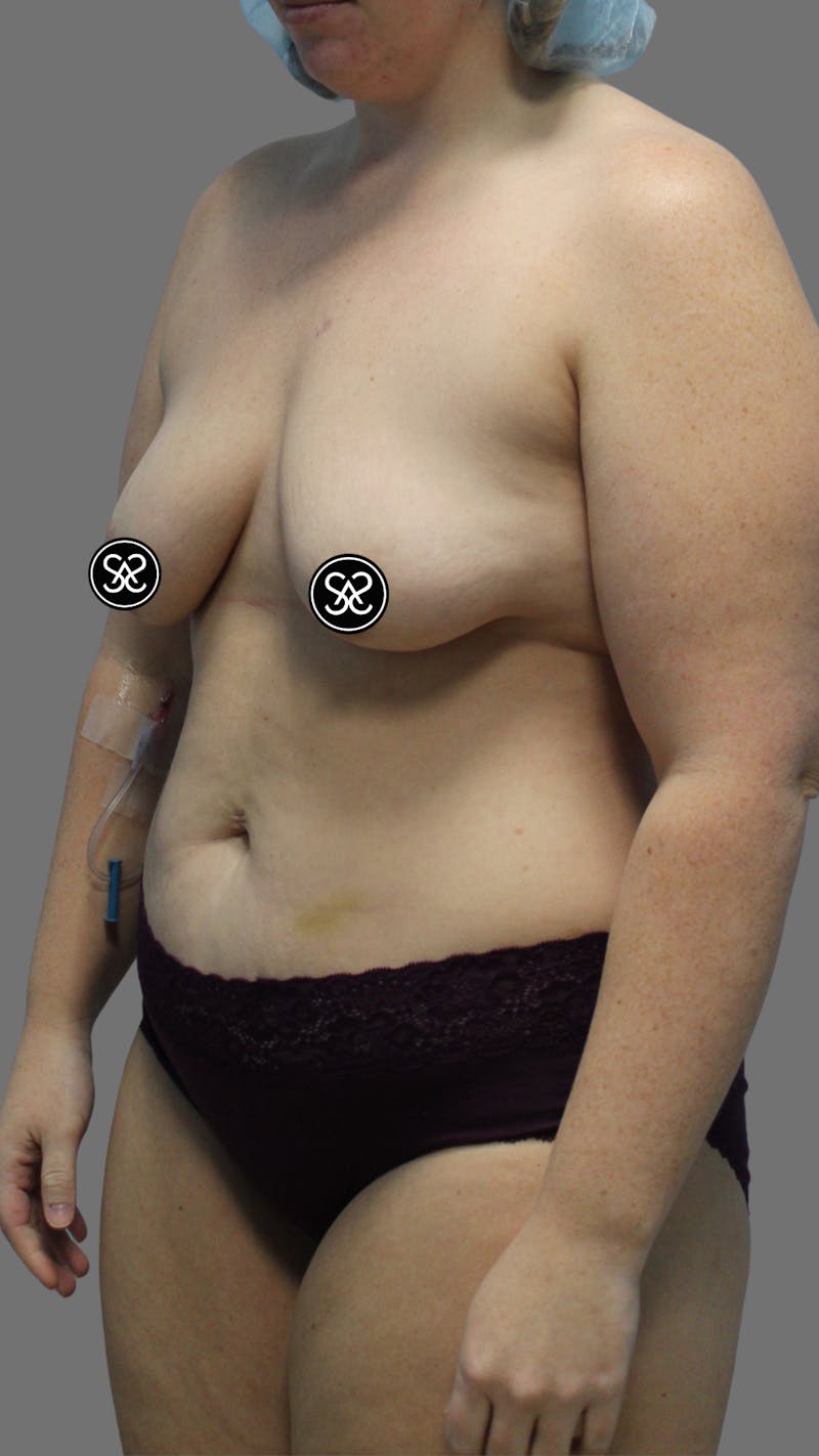 High Definition Mommy Makeover Before & After Gallery - Patient 368571 - Image 5