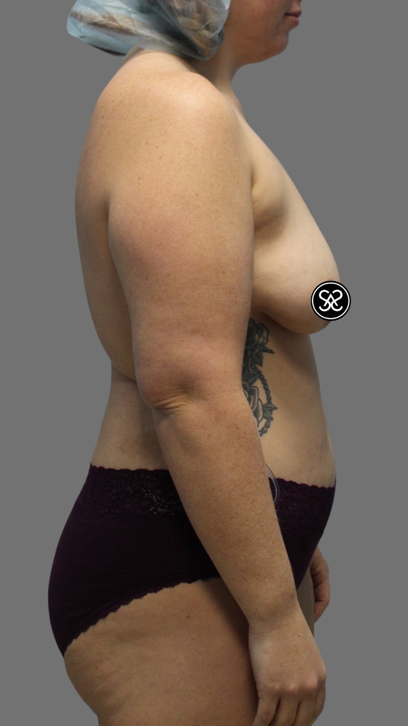 High Definition Mommy Makeover Before & After Gallery - Patient 368571 - Image 3