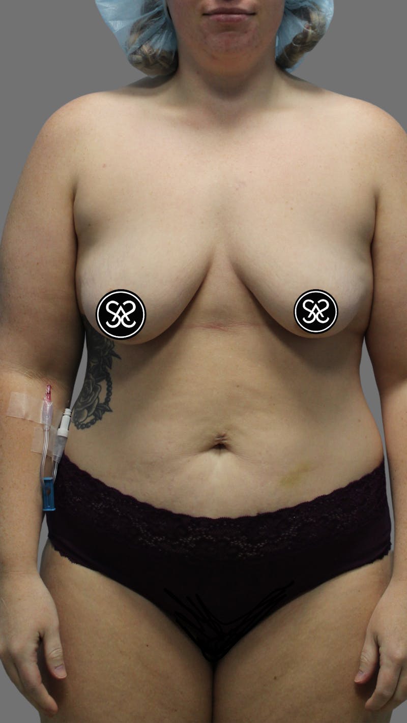 High Definition Mommy Makeover Before & After Gallery - Patient 368571 - Image 1