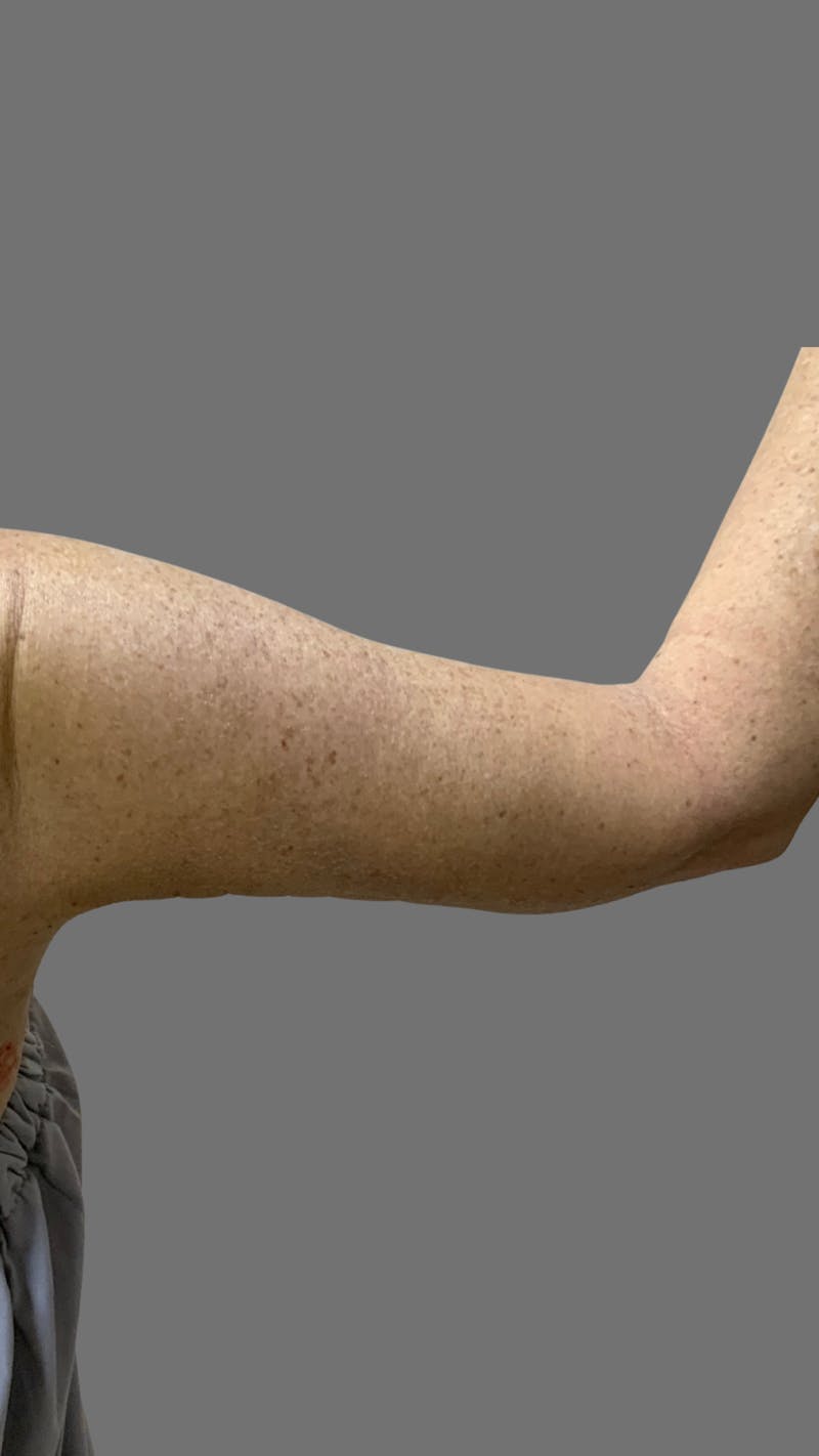 Arm Lift (Scarless Arm Lift) Before & After Gallery - Patient 121506 - Image 4