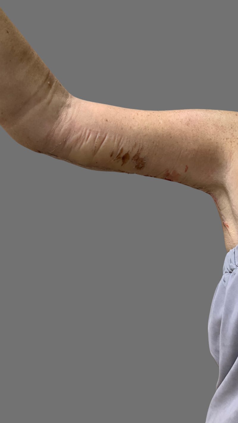 Arm Lift (Scarless Arm Lift) Before & After Gallery - Patient 121506 - Image 6