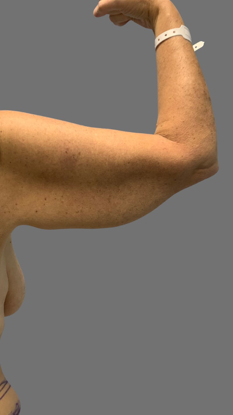 Arm Lift (Scarless Arm Lift) Before & After Gallery - Patient 121506 - Image 3