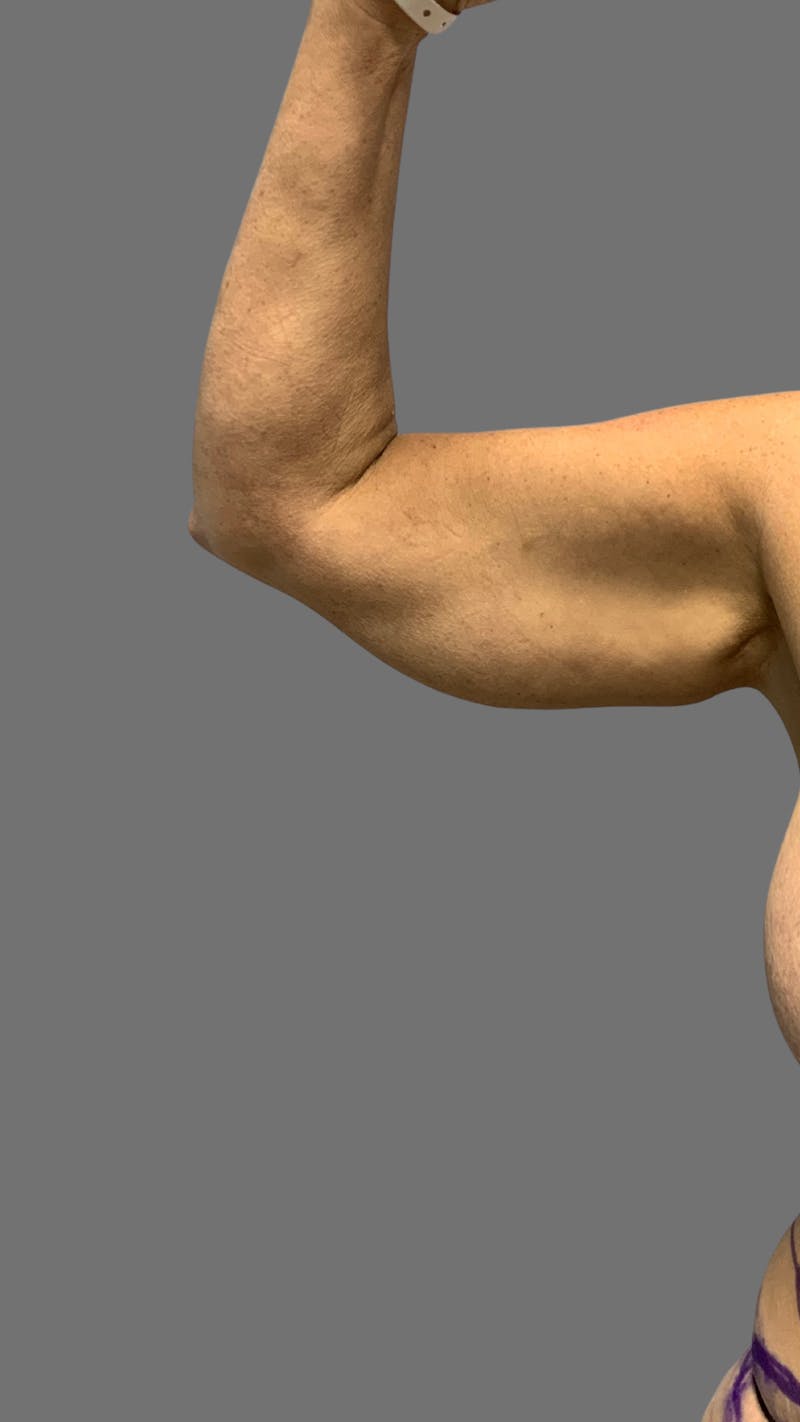 Arm Lift (Scarless Arm Lift) Before & After Gallery - Patient 121506 - Image 5