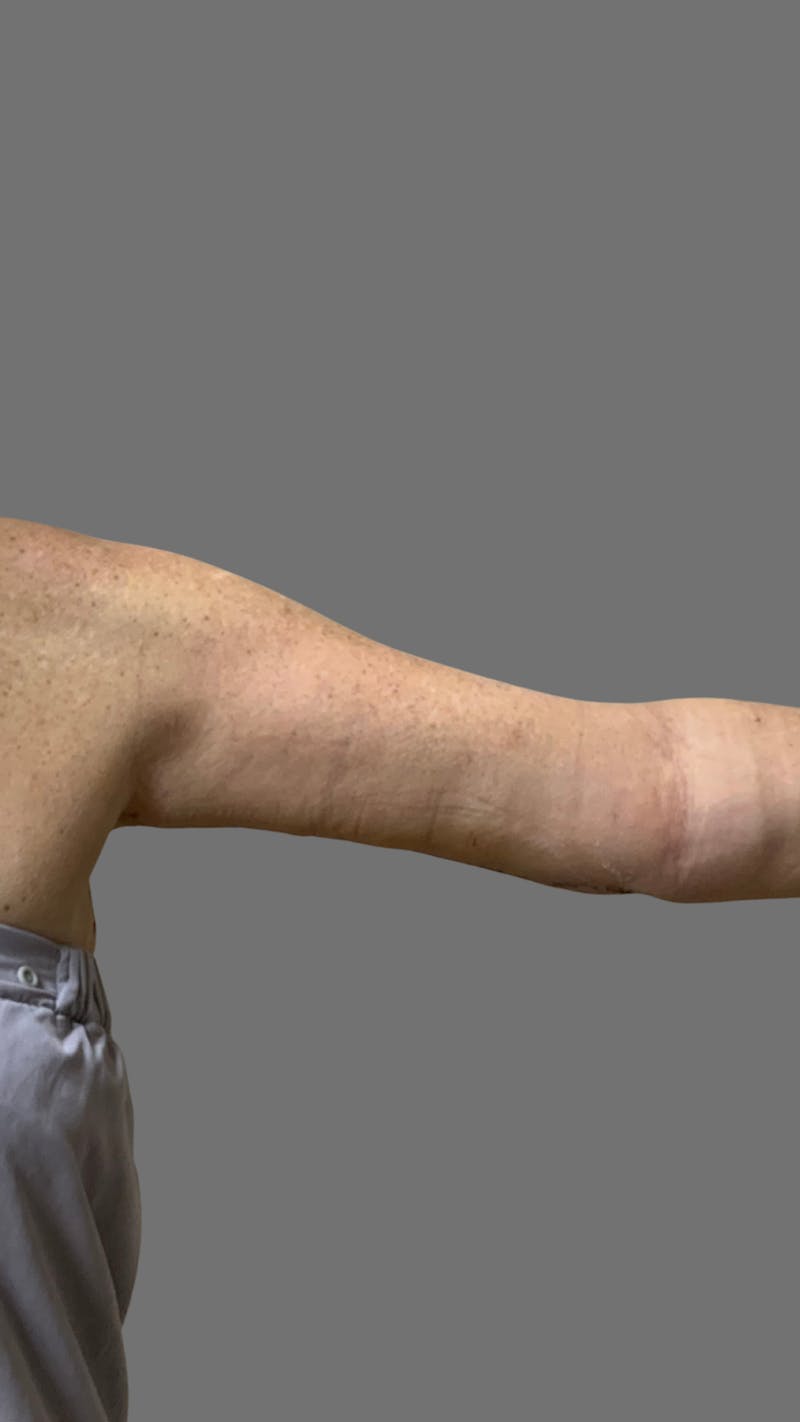 Arm Lift (Scarless Arm Lift) Before & After Gallery - Patient 121506 - Image 1