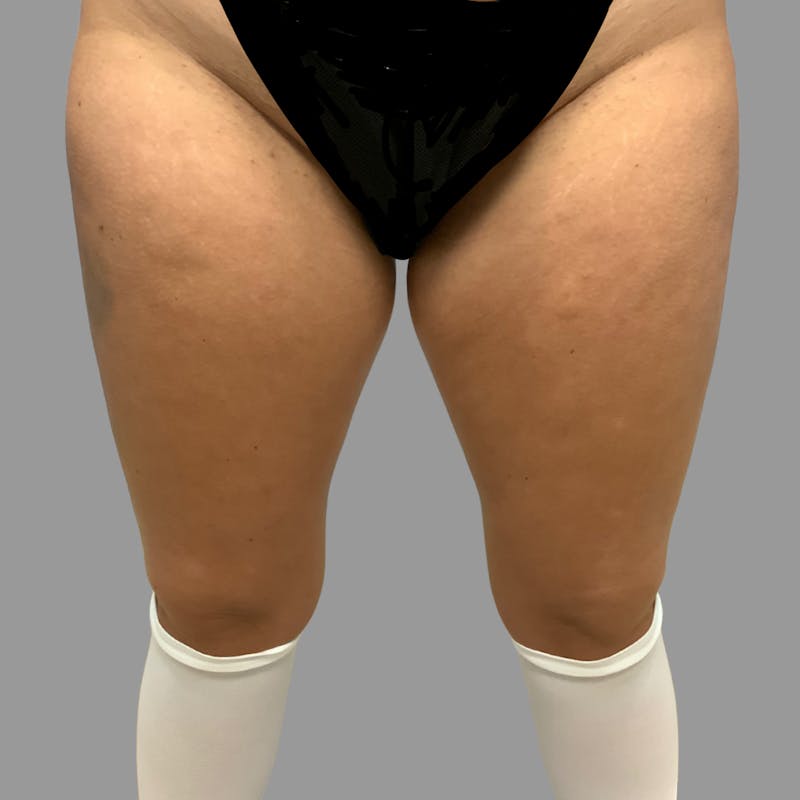 Liposuction Before & After Gallery - Patient 103443 - Image 1
