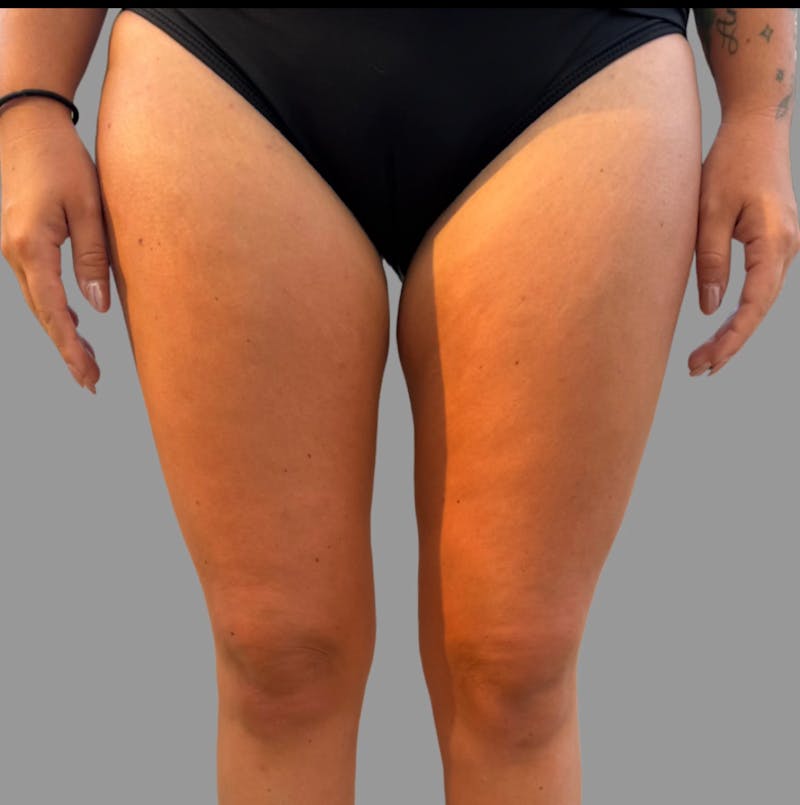 Liposuction Before & After Gallery - Patient 103443 - Image 2