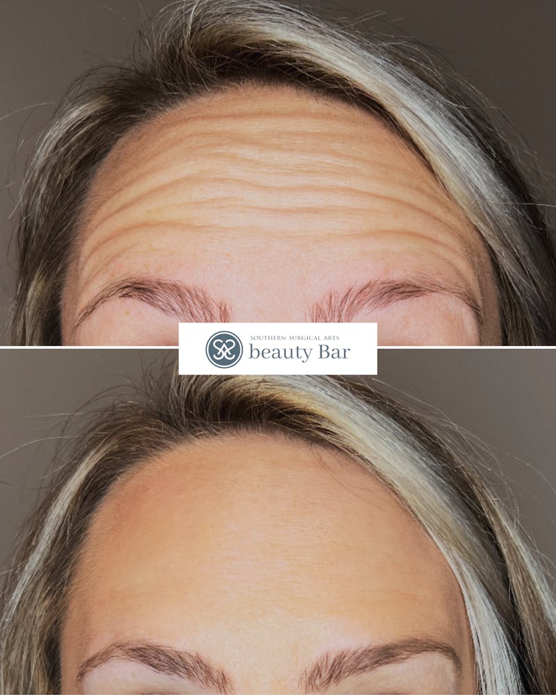 Neuromodulator Injections Before & After Gallery - Patient 375172 - Image 1