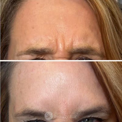 Neuromodulator Injections Before & After Gallery - Patient 733308 - Image 1