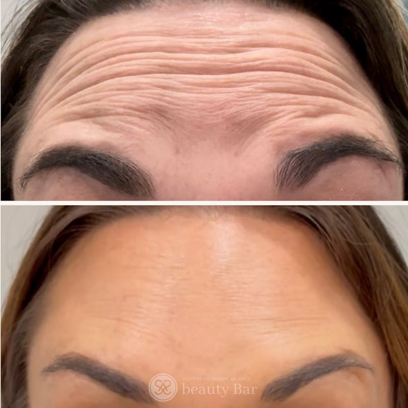 Neuromodulator Injections Before & After Gallery - Patient 188280 - Image 1