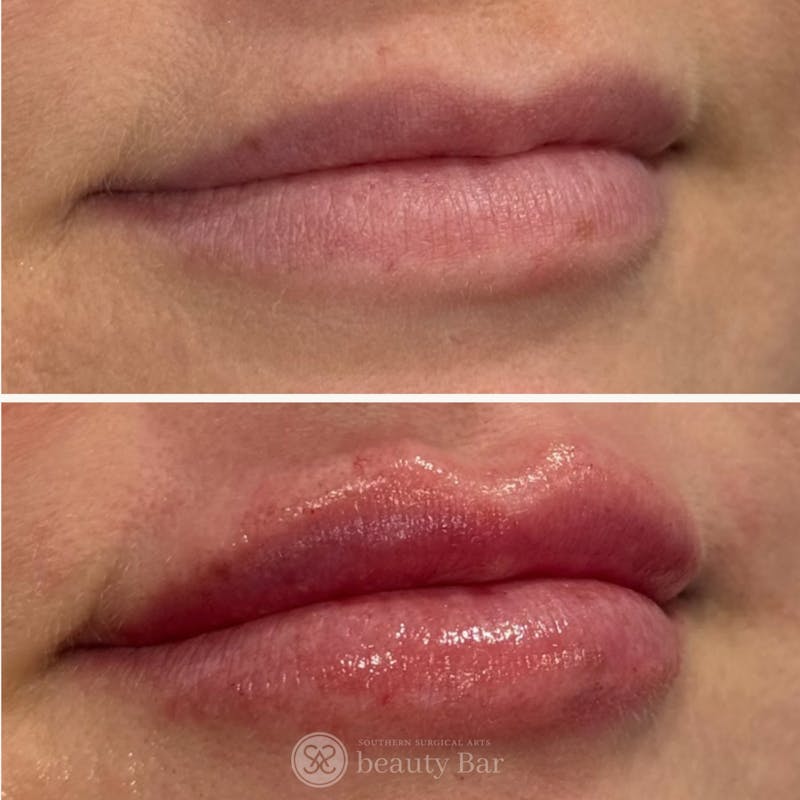 Facial Fillers Before & After Gallery - Patient 983876 - Image 1