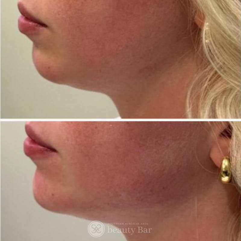 Facial Fillers Before & After Gallery - Patient 258861 - Image 1