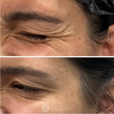 Neuromodulator Injections Before & After Gallery - Patient 406738 - Image 1