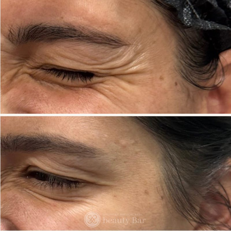 Neuromodulator Injections Before & After Gallery - Patient 406738 - Image 1