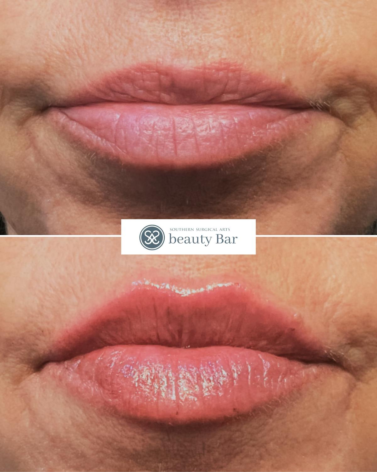 Facial Fillers Before & After Gallery - Patient 355478 - Image 1