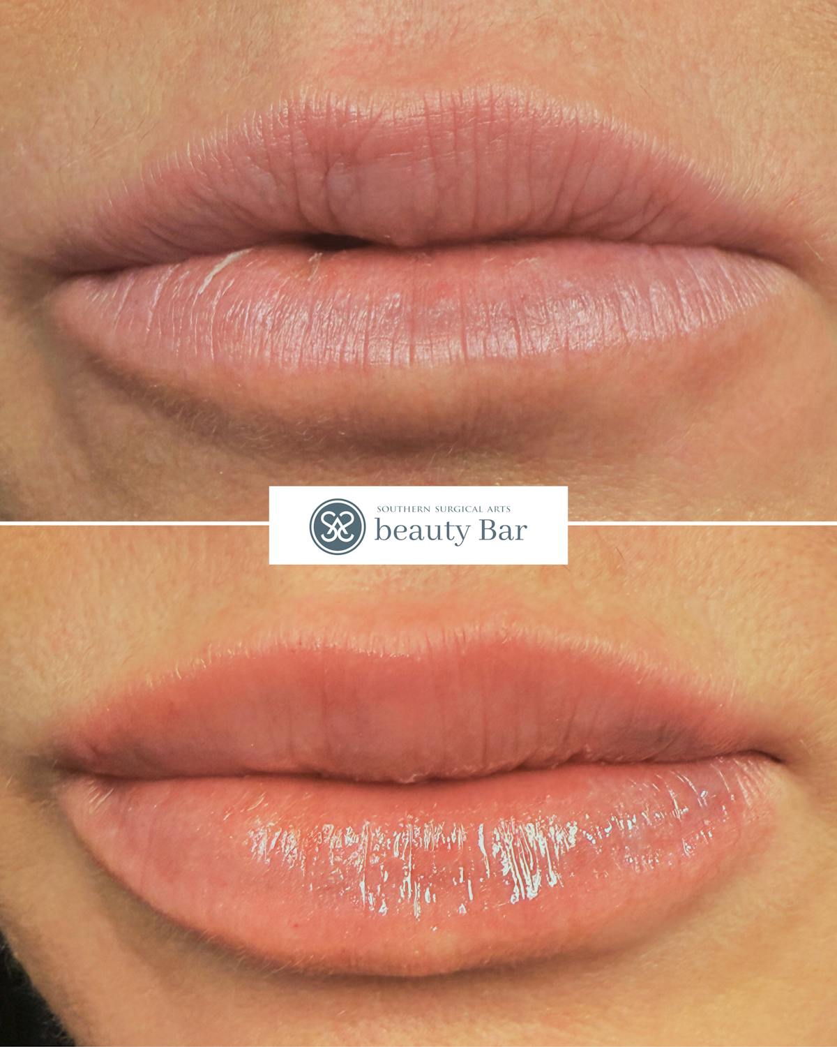 Facial Fillers Before & After Gallery - Patient 160810 - Image 1