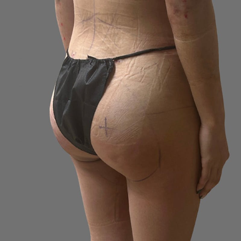 Brazilian Butt Lift Before & After Gallery - Patient 381026 - Image 4