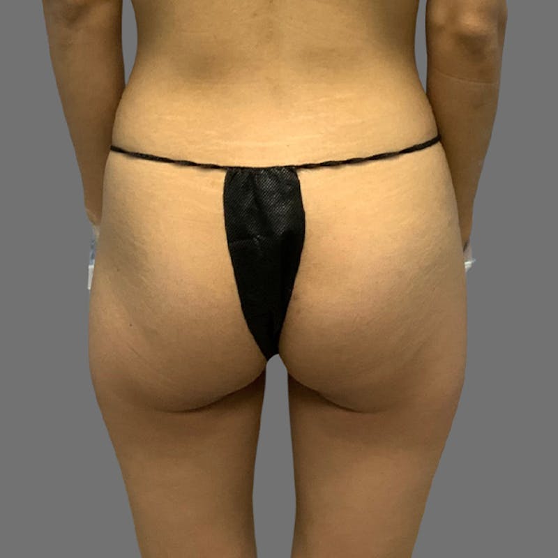Brazilian Butt Lift Before & After Gallery - Patient 381026 - Image 1